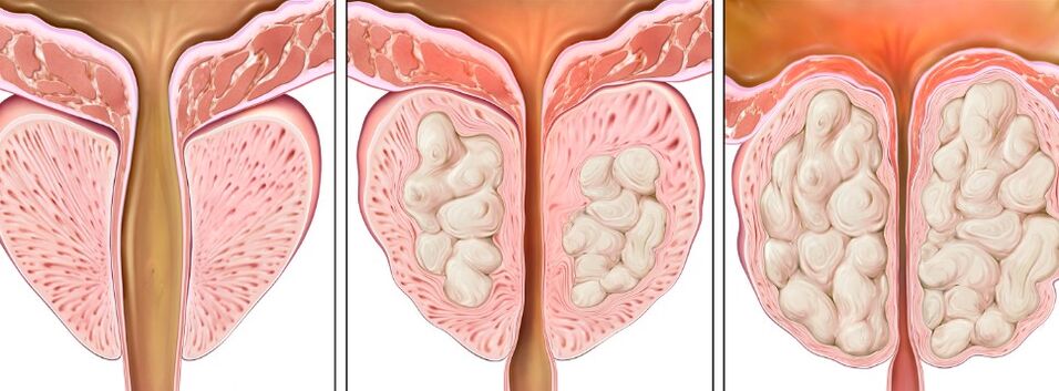 Stages of the prostatitis