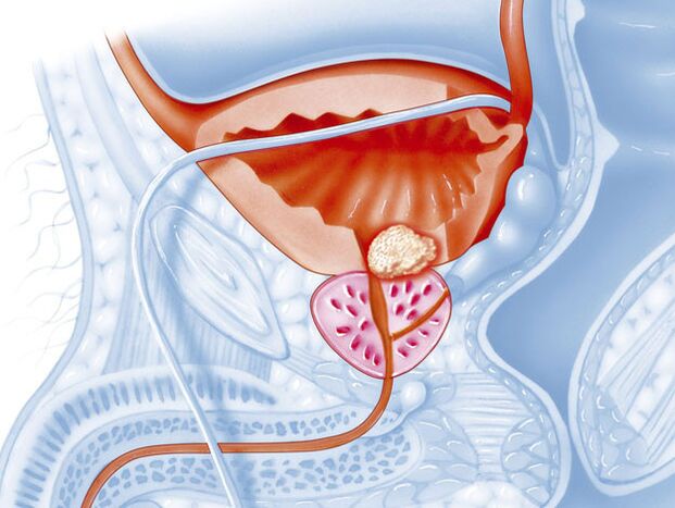 Prostatitis bacterial form